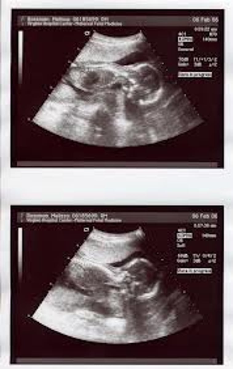 <p>an image formed using reflected ultrasound waves; obstetrics, emergency medicine, other diagnostic procedures</p>