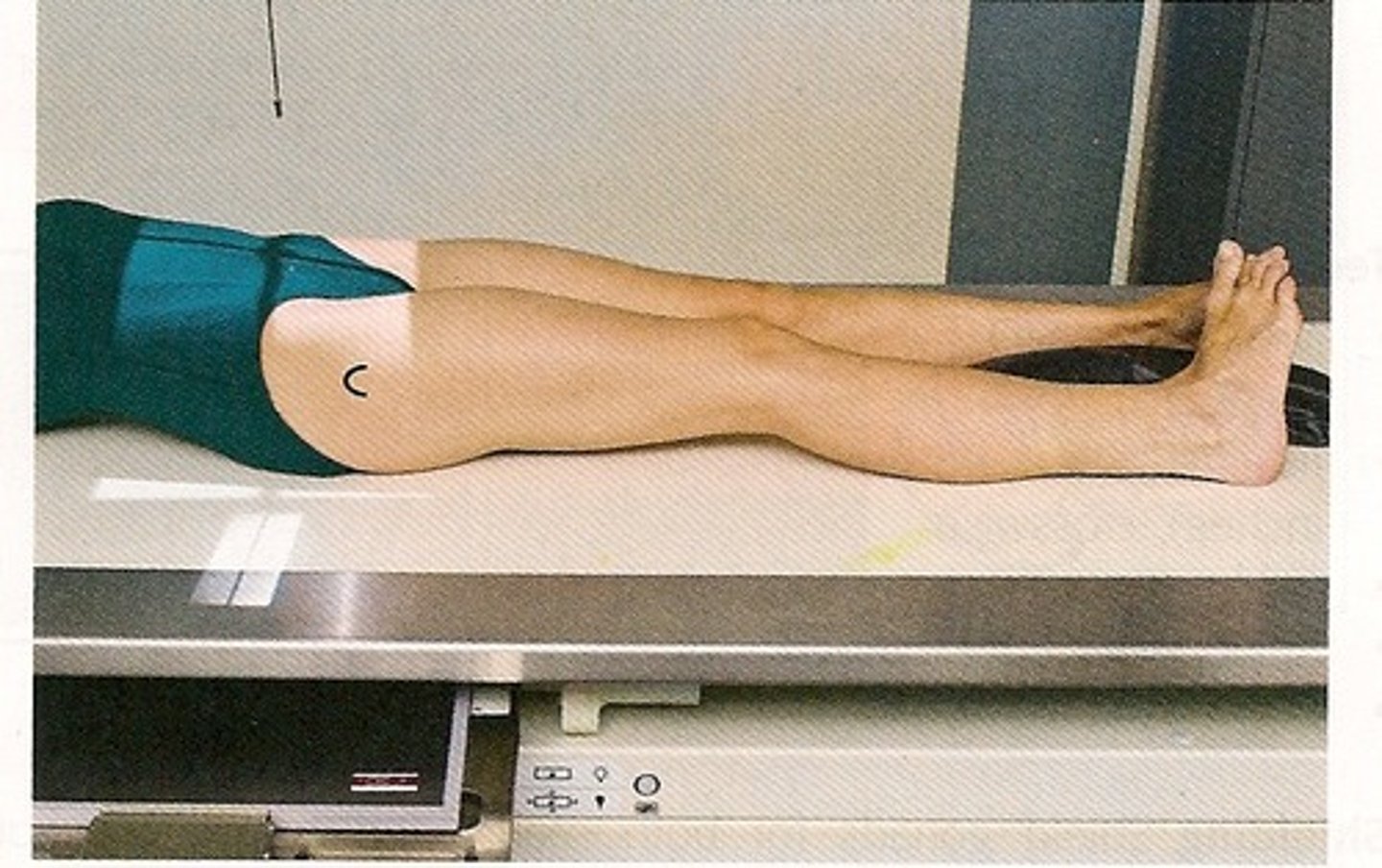 <p>perpendicular and directed midway between ASIS and pubic symphysis</p>