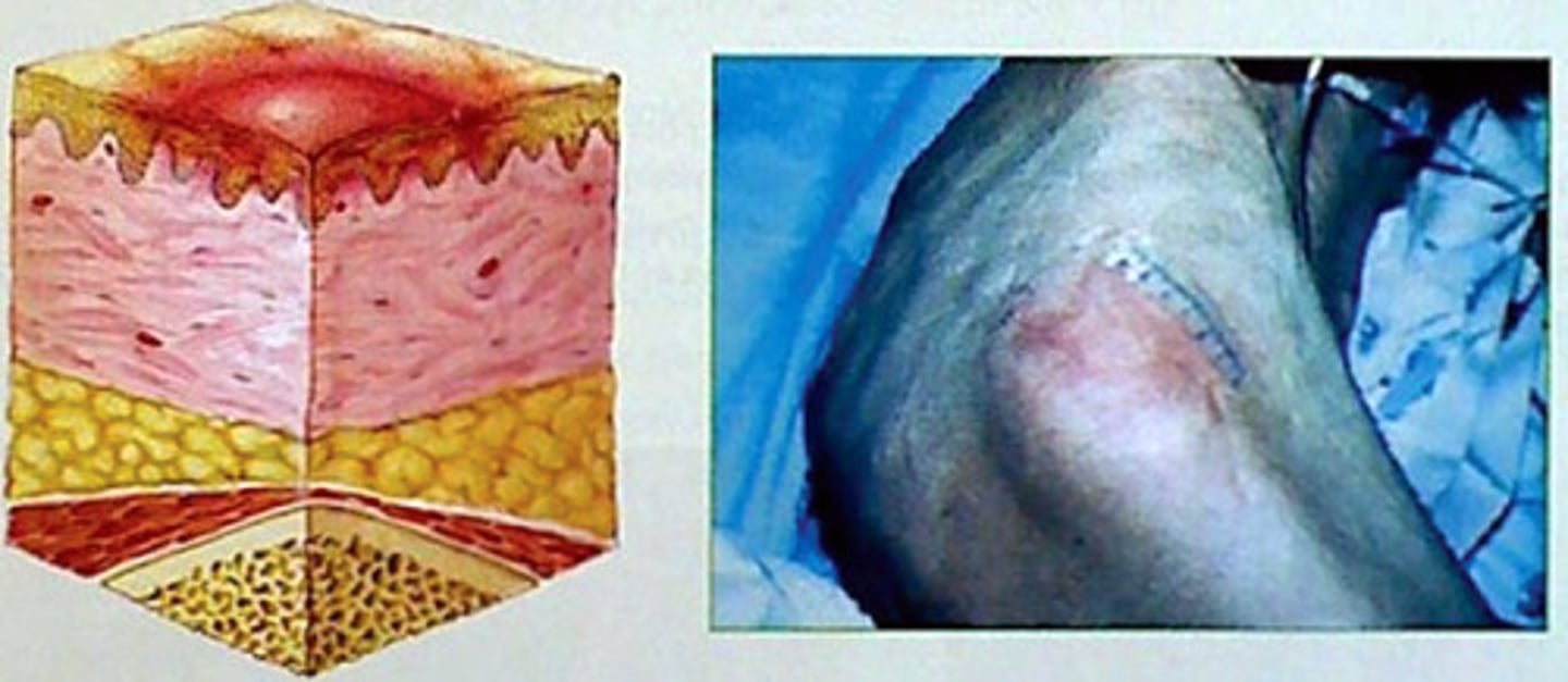 <p>- skin is intact</p><p>- area, usually over a bony prominence, red and does not blanch with external pressure</p>