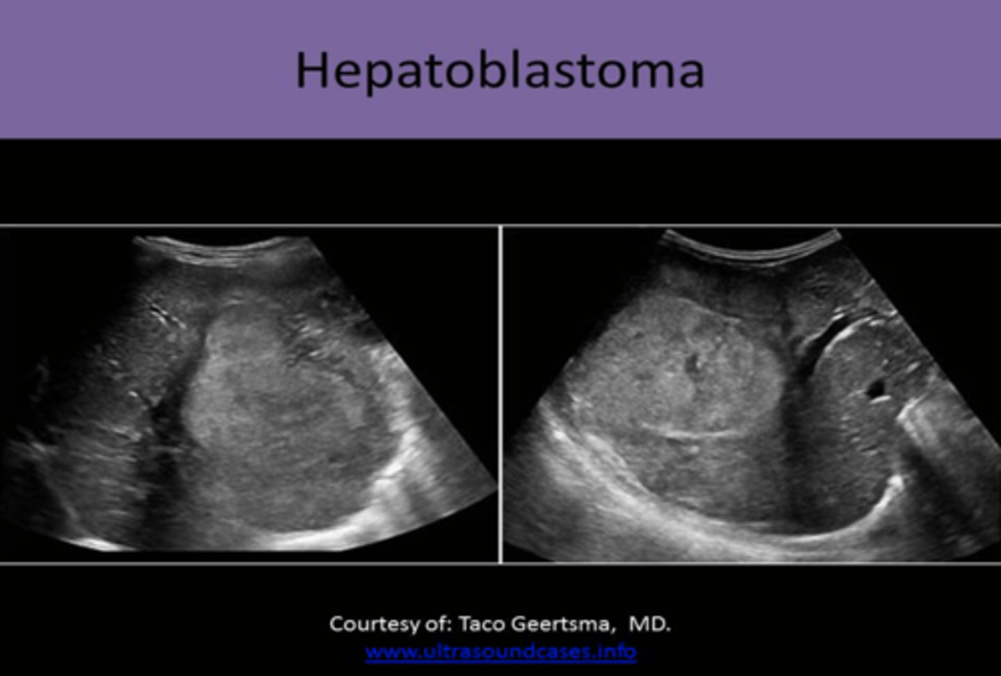 <p>1. SOLID, ECHOGENIC mass<br>2. may have some CYSTIC PORTIONS/SEPTATIONS<br>3. may contain CALCIFICATIONS<br>4. tendency to INVADE HEPATIC AND PORTAL VEINS</p>