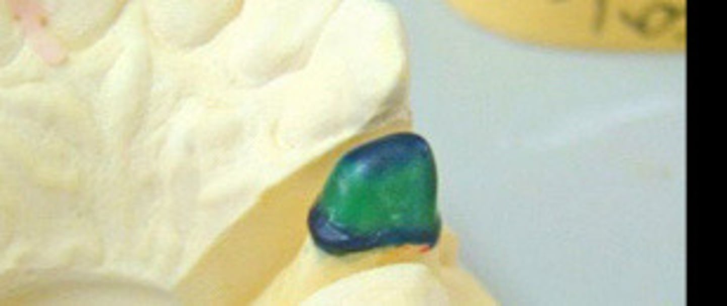 <p>1) __ for metal coping</p>