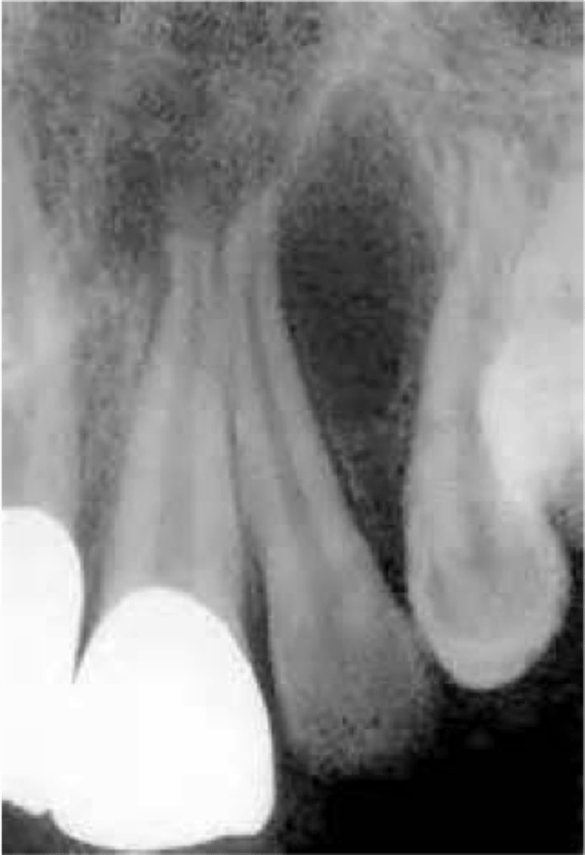 <p>histology: OKC, periapical cyst, lateral periodontal cyst</p><p>radio: well-defined radiolucency bt the maxillary lateral incisor/canine</p>