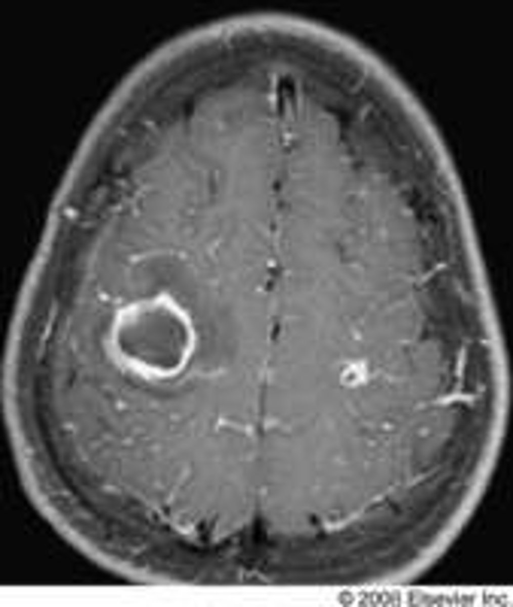 <p>Region of the brain that has been damaged</p><p>- HUMANS: damage occurs by natural diseases/trauma (never done on purpose)</p><p>- ANIMALS: damage is done on purpose</p>