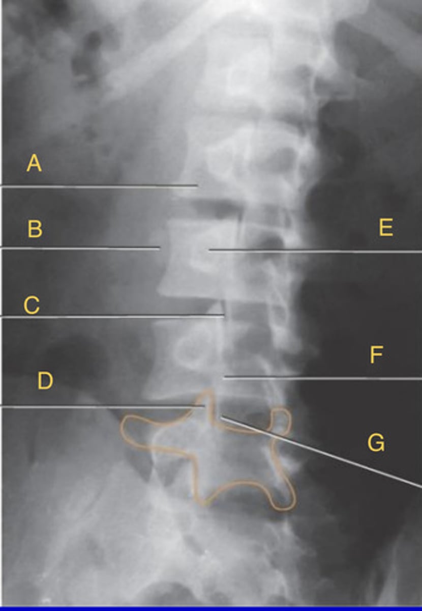 <p>Oblique lumbar</p>