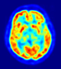 <p>a visual display of brain activity that detects where a radioactive form of glucose goes while the brain performs a given task</p>