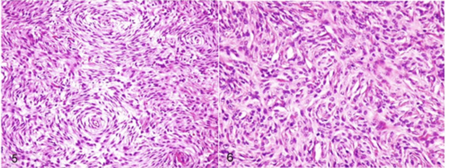 <p>what disease is represented by these histological pictures?</p>