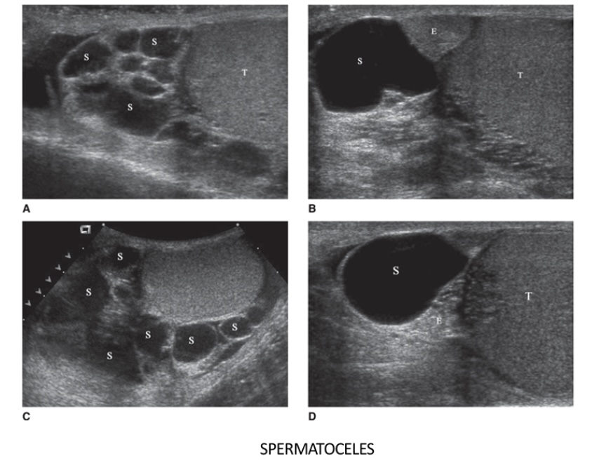 <p>What does the following describe?</p><ul><li><p>usually displace the testis anteriorly, distinguishing them from a hydrocele, the latter of which surrounds the testis</p></li></ul><ul><li><p>﻿﻿They are usually unilocular</p></li><li><p>﻿﻿Fluid is thick, milky, containing spermatozoa and has non viable sperms, fat lymphocytes</p></li></ul>