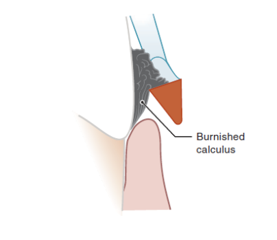 <p>removing only outer layers of deposits (instrument angulation less than 45 deg) </p><ul><li><p>smooth, burnished deposits are more difficult to remove and the plaque biofilm continues to live on and cause damage at burnished deposits. </p></li></ul><p></p>