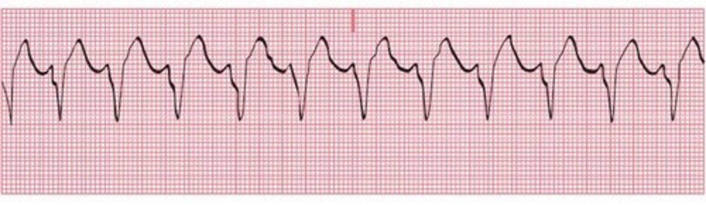 <p>B) ventricular tachycardia</p>