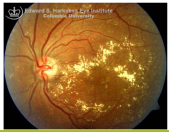 <ul><li><p>Well circumscribed, shiny, <strong>yellow deposits</strong> located within the retina</p></li><li><p>Arise at areas of retinal edema and indicate increased capillary permeability</p></li><li><p>Contain lipoproteins and lipid laden macrophages</p></li></ul><p></p>