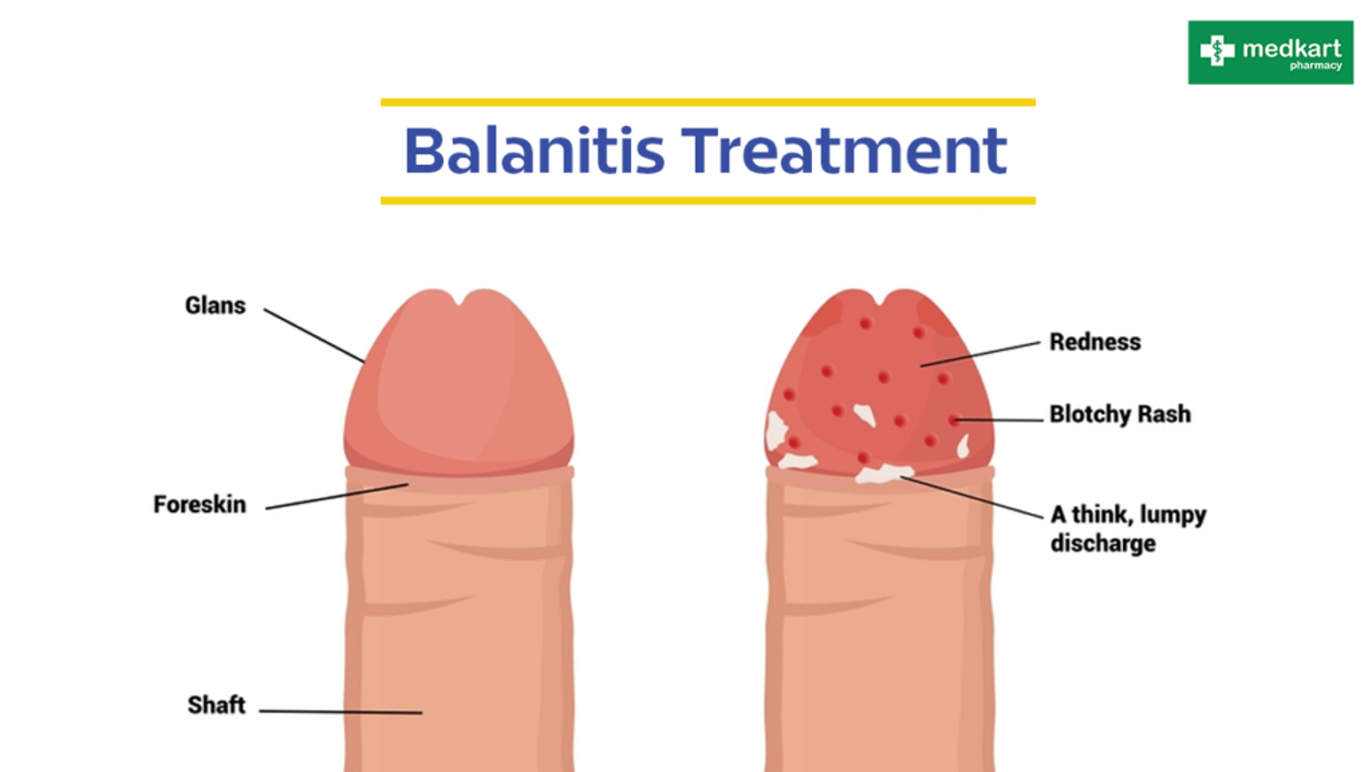 <p>Balanitis</p>