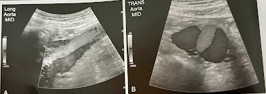 <p>A 60 year old woman undergoes sonography of the Ao. She reports recent episodes of fainting and abd. back pain. She has a hx of poorly controlled hypertension and aortic aneurysm. An abd. sonogram is performed to check the status of the aneurysm. A new finding of linear echo is identified w/in the Ao, and color confirms flow on both sides of this flap. What is the most likely diagnosis? What symptoms, risk factors, and clinical presentation does she have to support the findings?</p>