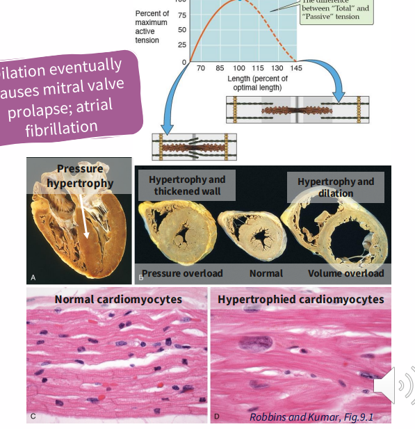 <p>Congestive Heart Failure: Compensation</p>