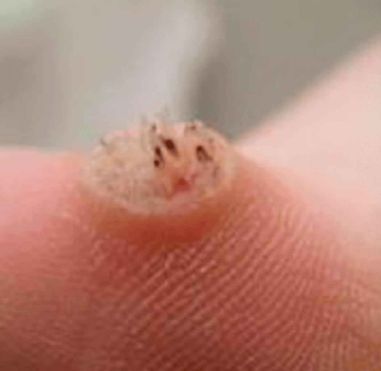<p>Viral Skin Infections:</p><p>aka <strong>warts</strong></p><p>- <strong>discrete, benign epithelial hyperplasia w surface hyperkeratosis</strong></p><p>- caused by h<strong>uman papillomavirus (HPV)</strong></p><p>- skin-to-skin contact transmission</p><p>- don't usually get healed easily (can last for years if untreated)</p>