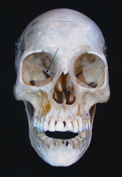 superior orbital fissure 