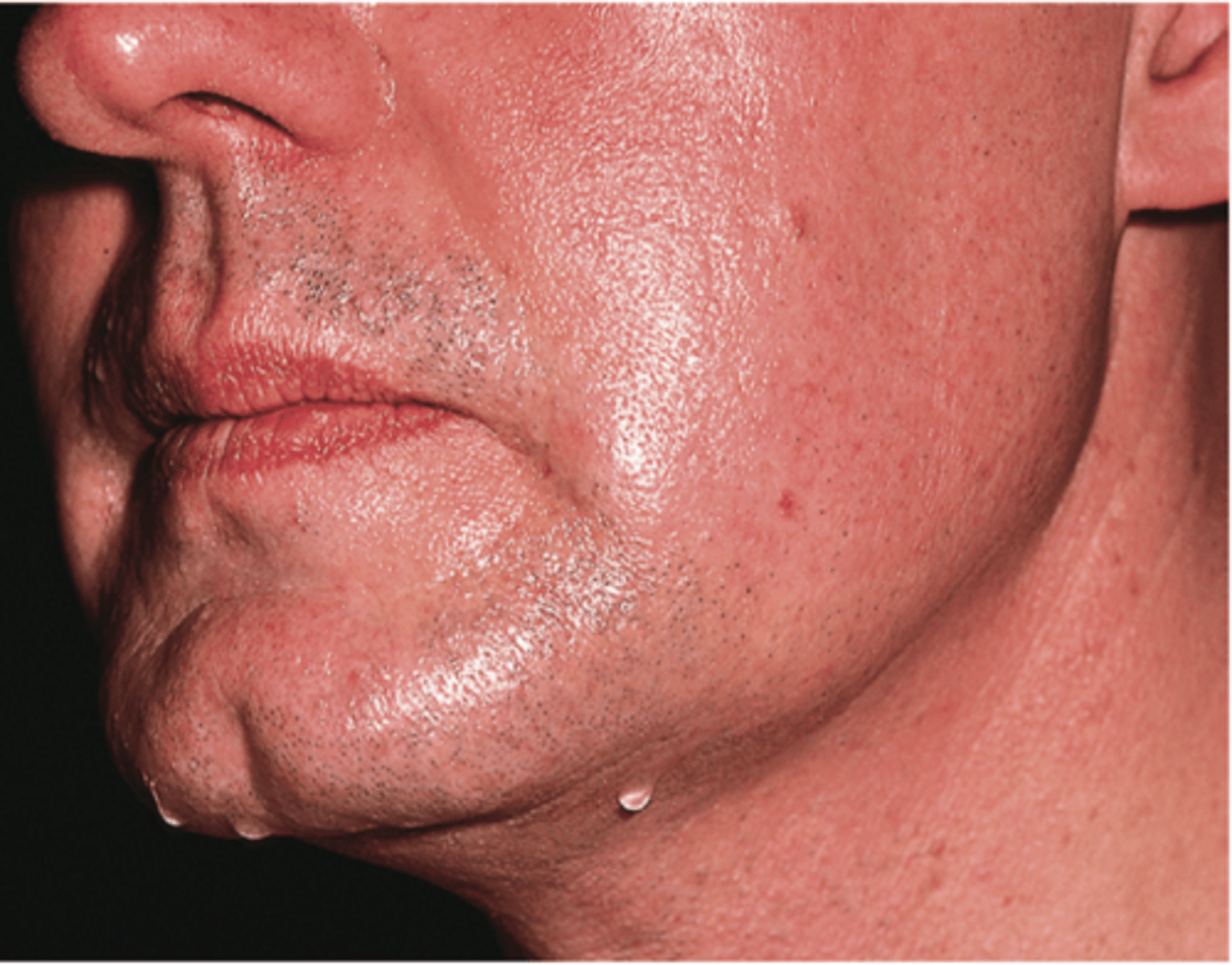 <p>abnormal condition of excessive sweat caused by heat, genetics or medications</p>