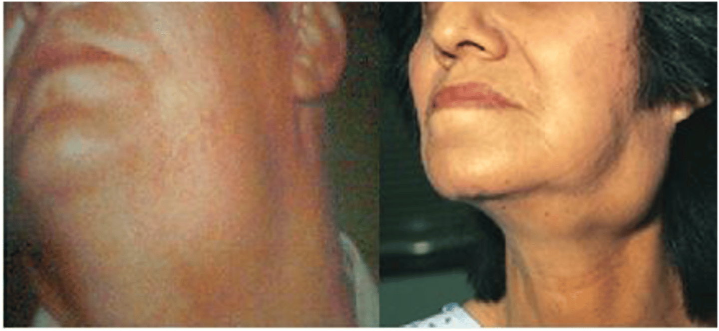 <p>PAINFUL swelling of major/minor salivary gland </p>