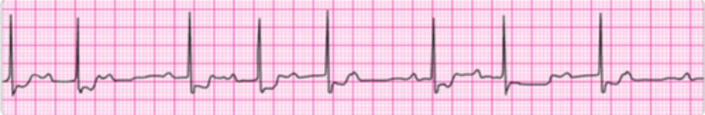 <p>You are evaluating a patient with chest discomfort lasting 15 minutes during transportation to the emergency department. He is receiving oxygen and 2 sublingual nitroglycerin tablets have relieved his chest discomfort. He reports no other symptoms but appears anxious. Blood pressure is 130/70 mm Hg. You observe the rhythm below on the monitor. What is your next action?</p><p>1. Give atropine 0.5 mg IV.</p><p>2. Initiate transcutaneous pacing (TCP).</p><p>3. Start epinephrine 2 to 10 mcg/min and titrate to patient response.</p><p>4. Continue monitoring the patient and seek expert consultation.</p><p>5. Administer sublingual nitroglycerin 0.4 mg.</p>
