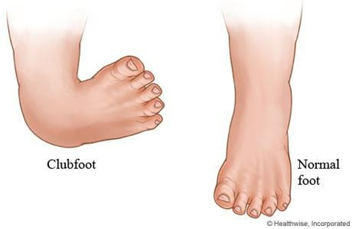 <p>Clubfoot or talipes equinovarus (TEV).</p>