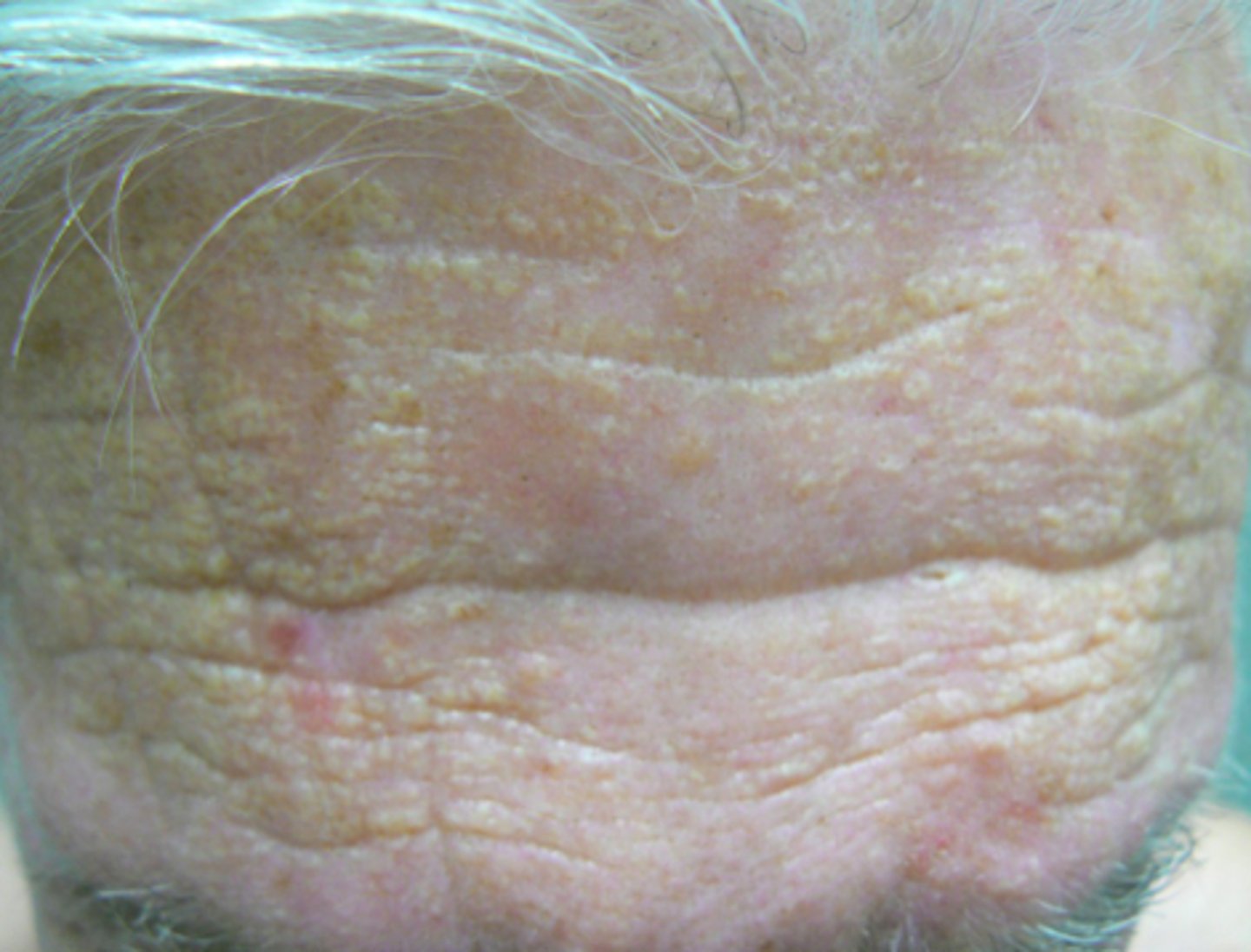 <p>Yellowish white macules or papules on sun exposed skin, especially the forehead</p>
