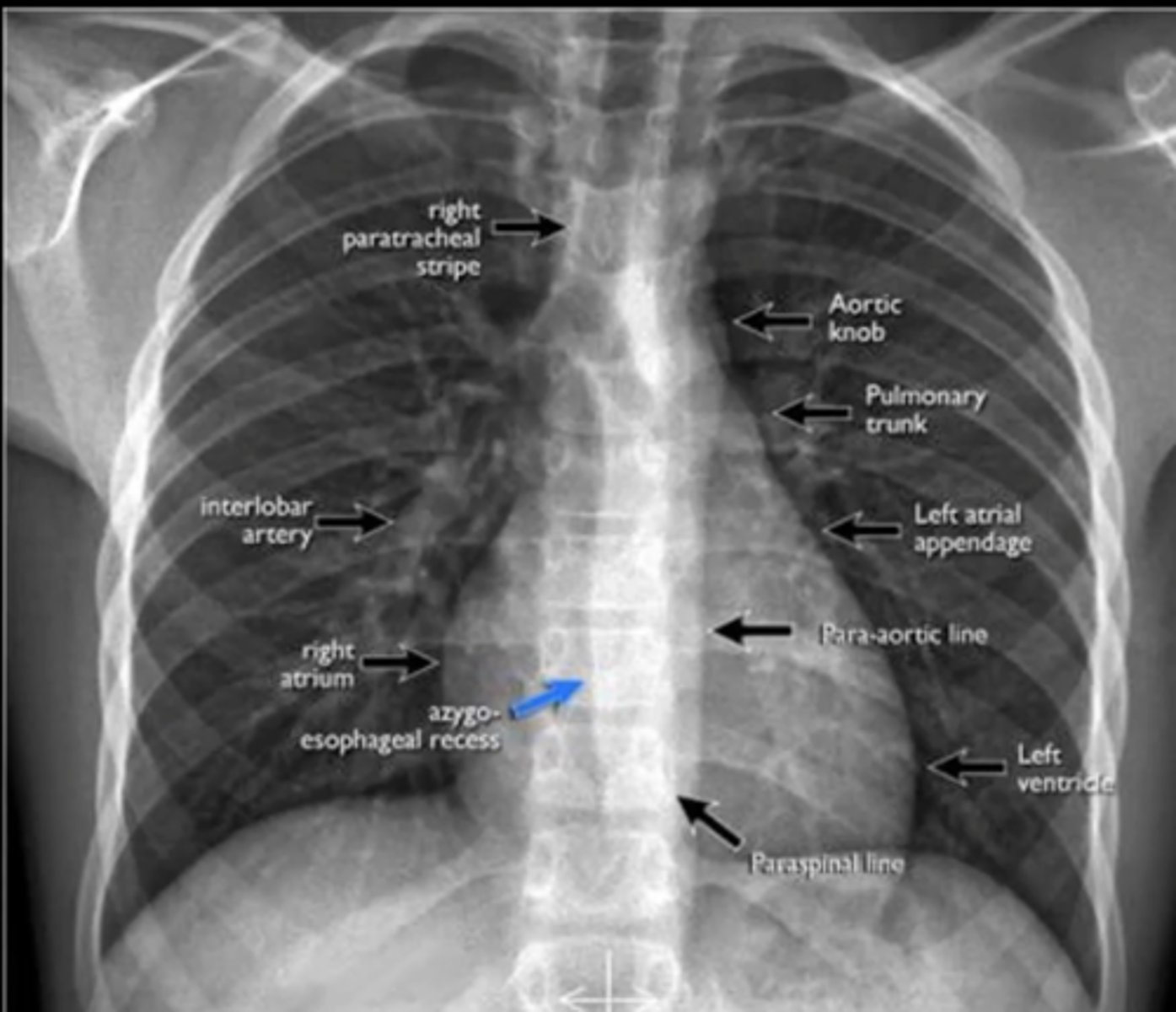 <p>(evaluating AP CXR) right paratracheal stripe</p>