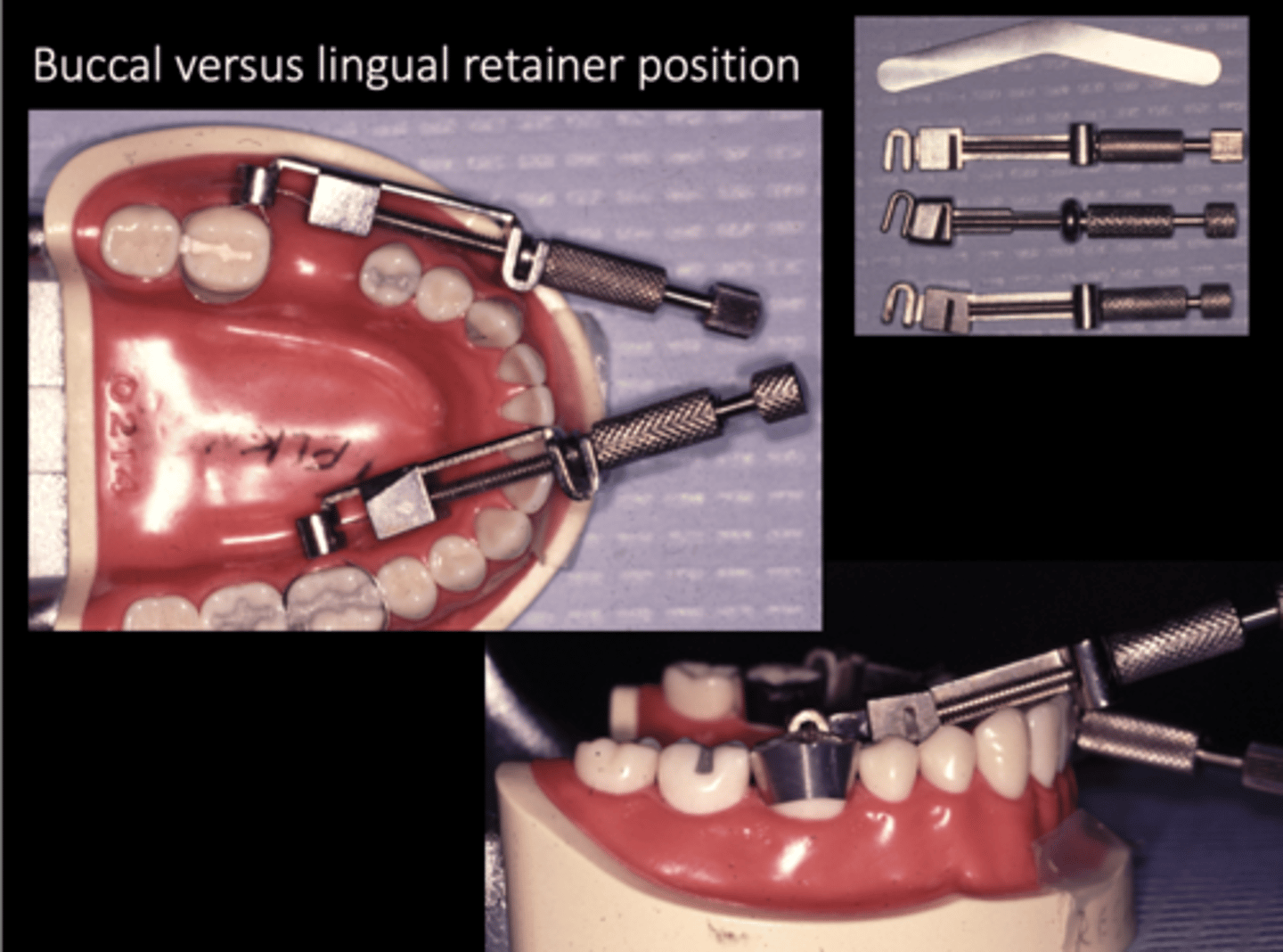 <p>buccal side</p><p>exception = missing buccal wall/ support</p>