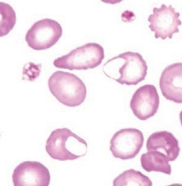 <p><span style="font-family: "Times New Roman", serif">RBCs with a vacuole or blister-like appearance, often a precursor to bite cells. Seen in oxidant damage.</span></p>