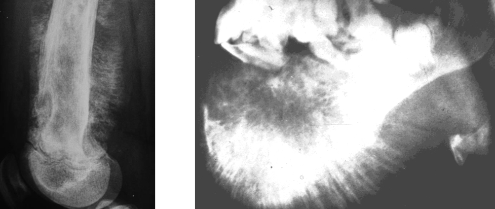 <p>Filiform radiating pattern seen in osteogenic sarcoma</p>