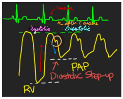 <p>Pulmonary Artery Pressure</p>