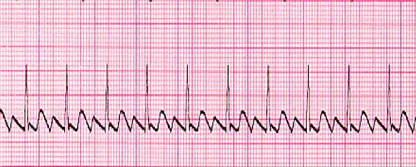 <p>What does the ECG show?</p>