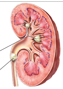 <p>= stones (crystals of calcium oxalate or uric acid) form in kidney tubules and migrate.</p><ul><li><p>can get lodged and obstruct urine flow (causing hydronephrosis)</p></li><li><p>abrupt, severe flank pain, nausea and vomiting, restlessness, hematuria</p></li></ul>