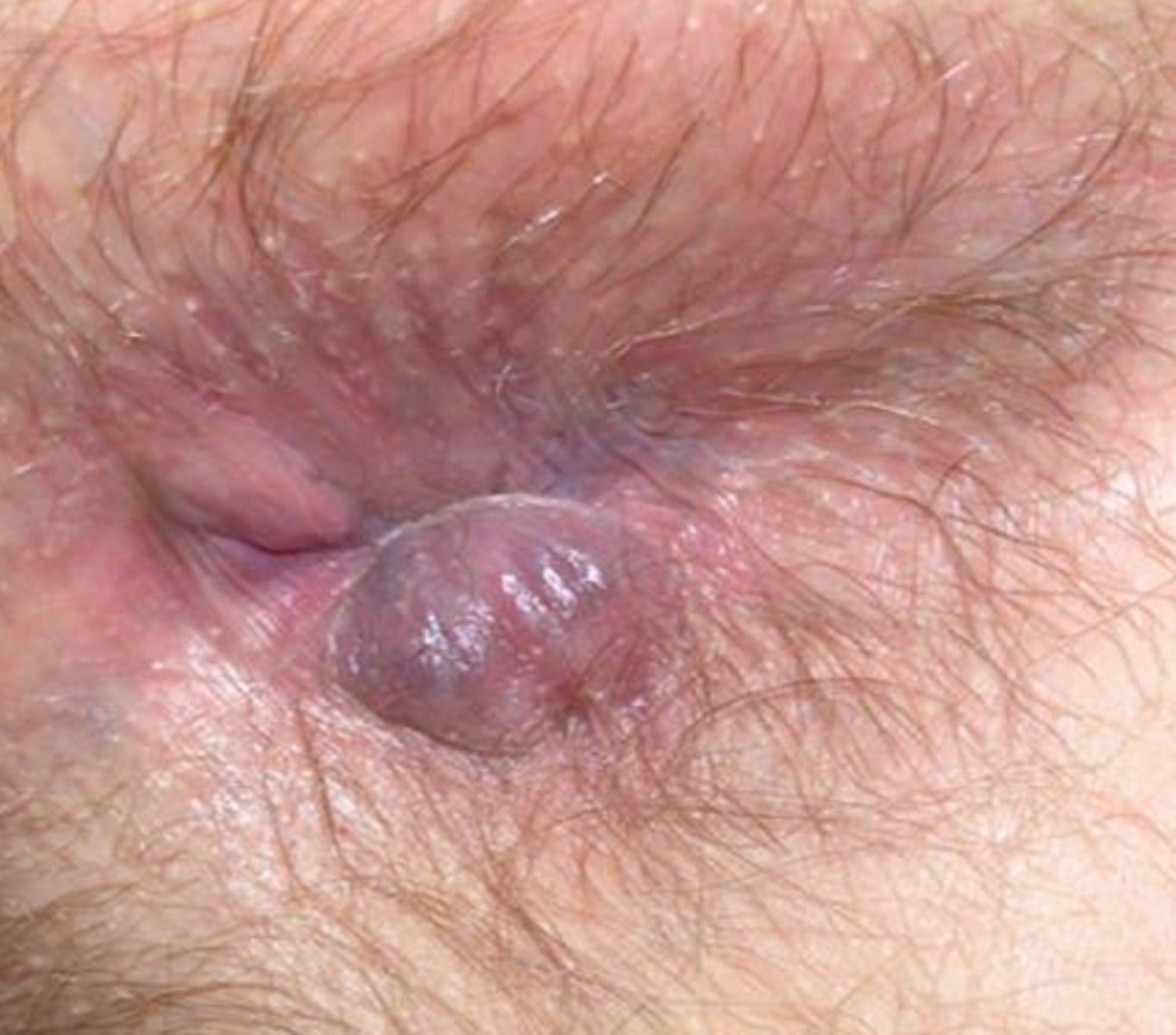 <p>-skin tag</p><p>-perianal skin irritation and pain (w/ sitting)</p><p>-pruritus</p>