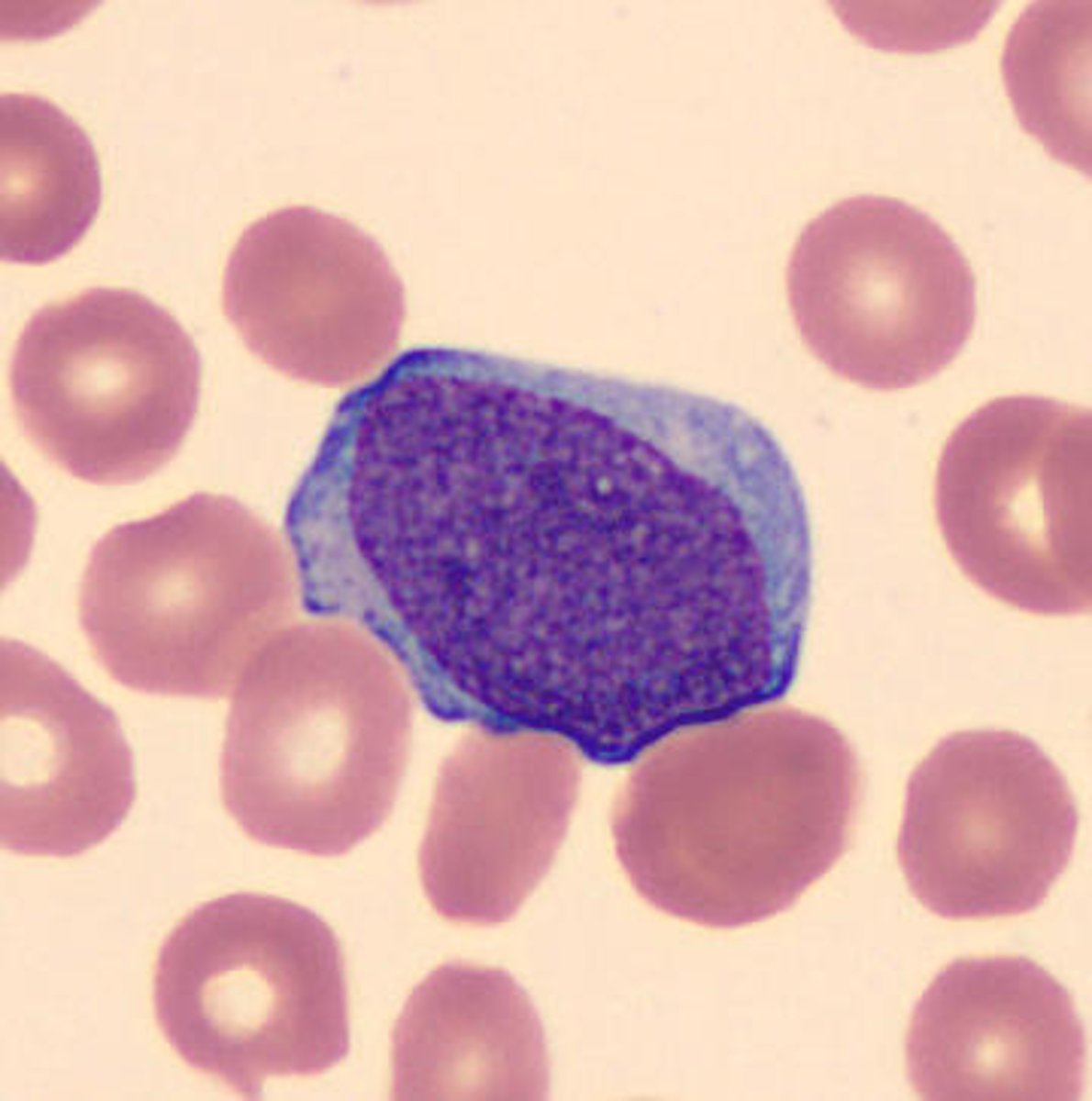 <p>-cytoplasmic granules, may see suer rods</p><p>-increased prominence of nucleoli</p>