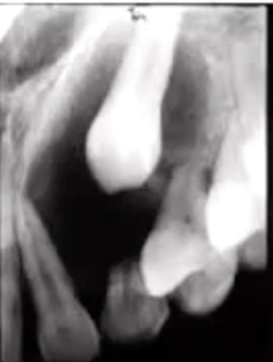 <p>radiolucency around the crown of an unerupted tooth that may contain calcifications</p><p>this is usually in the anterior maxilla (canines)</p>