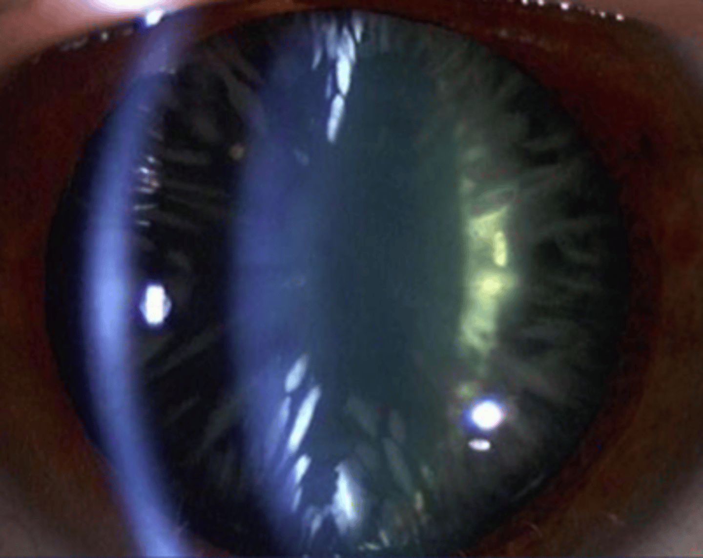<p>Cortical spoking cataract (CS) – Swelling of the cortex causing spoke/wedge-like peripheral cloudiness. Seen on slit lamp examination</p>