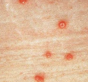 <p><strong>Molluscum Contagiosum: Diagnosis and Treatment</strong></p><p>-Diagnosis → _________, maybe a biopsy with histologic exam&nbsp;</p><p>-Treatment&nbsp;</p><ul><li><p>Starts to resolve within <em>_</em> months with complete clearing within&nbsp;_<em>-</em>__ months in immunocompetent patients&nbsp;</p></li><li><p>Cryotherapy</p></li><li><p>_________</p></li><li><p>Cantharidin (topical blistering agent)</p></li><li><p>________ acid (topical keratolytic agent)&nbsp;</p></li></ul><p></p>