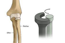 <p>a joint in which two ends of bones connect and allow for a ring movement around the joint</p>