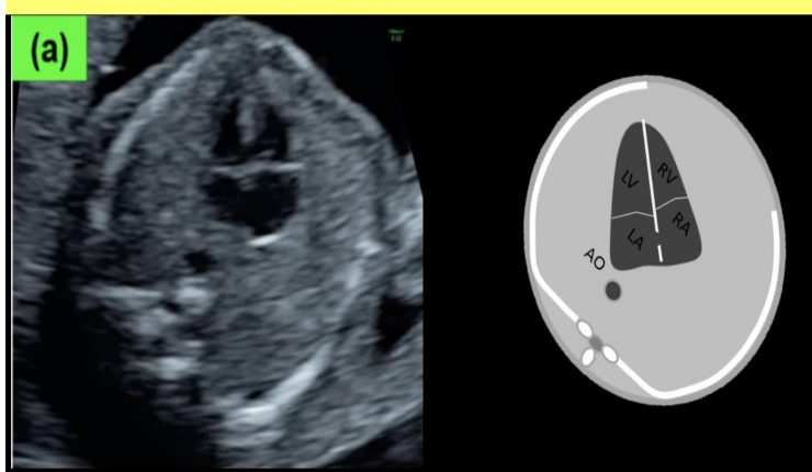 <p>c) left atrium</p>