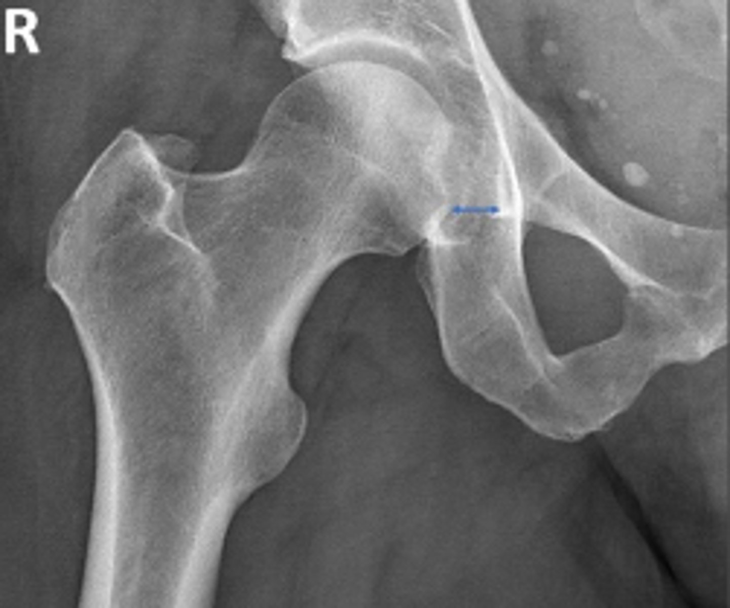 <p>What are the osseous landmarks for this assessment?</p>