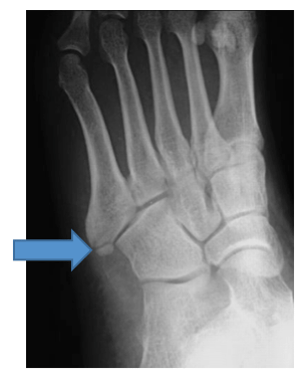 <p>enlarged & prominent to serve as insertion for fibularis brevis & tertius</p>