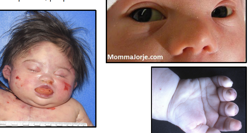 <p>● epicanthic folds, upslanting palpebral fissures, flat facies</p><p>● macroglossia</p><p>● mental retardation</p><p>● simian crease</p><p>● abundant neck skin</p><p>● congenital heart defects</p><p>● intestinal stenosis</p><p>● umbilical hernia</p><p>● hypotonia</p><p>● gap between first and second toes (saddle)</p>