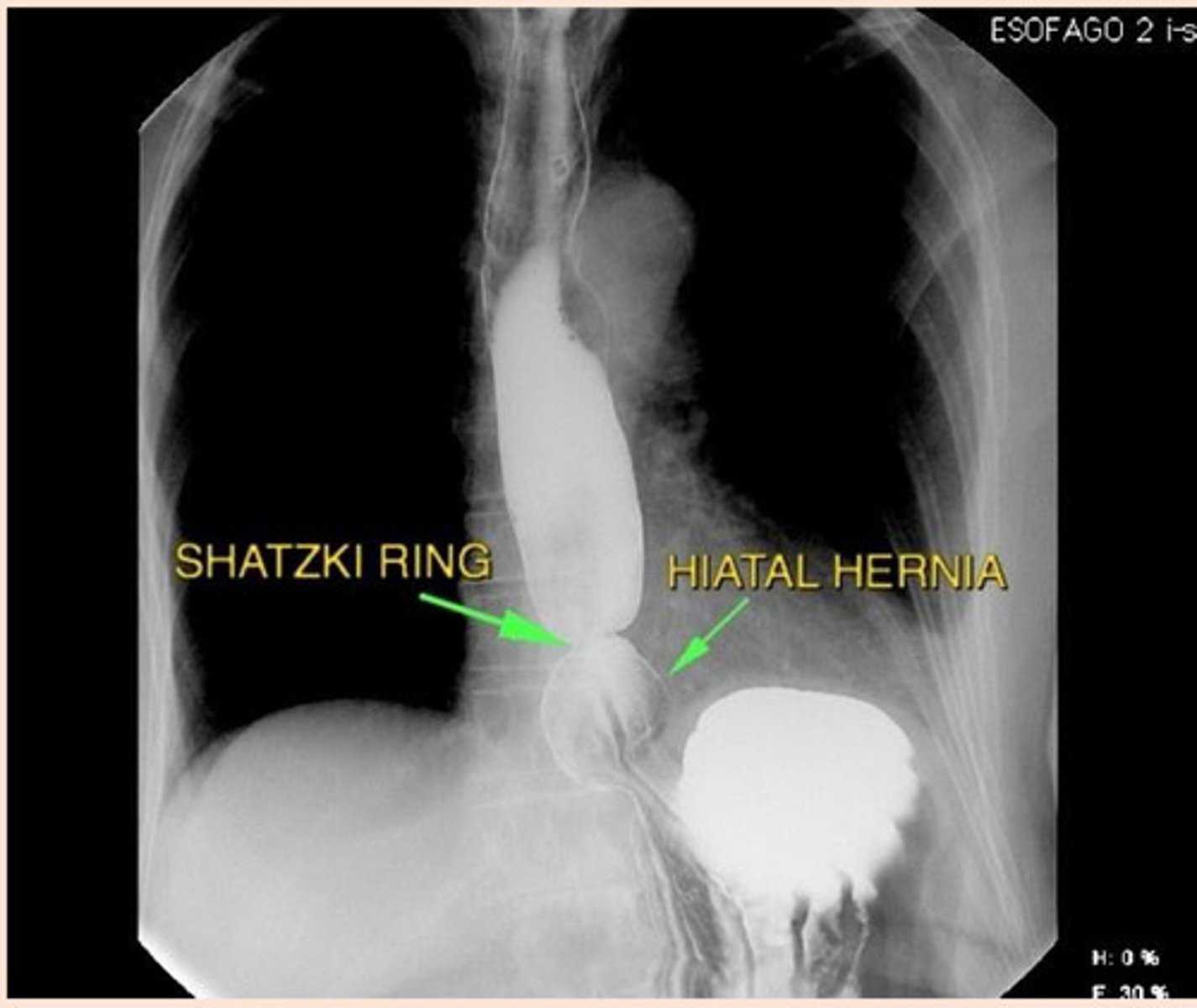 <p>symptomatic, narrow esophageal B ring occuring in the distal esophagus &amp; usu associated w/ a hiatal hernia; hx of food impactions; intermittent dysphagia</p>
