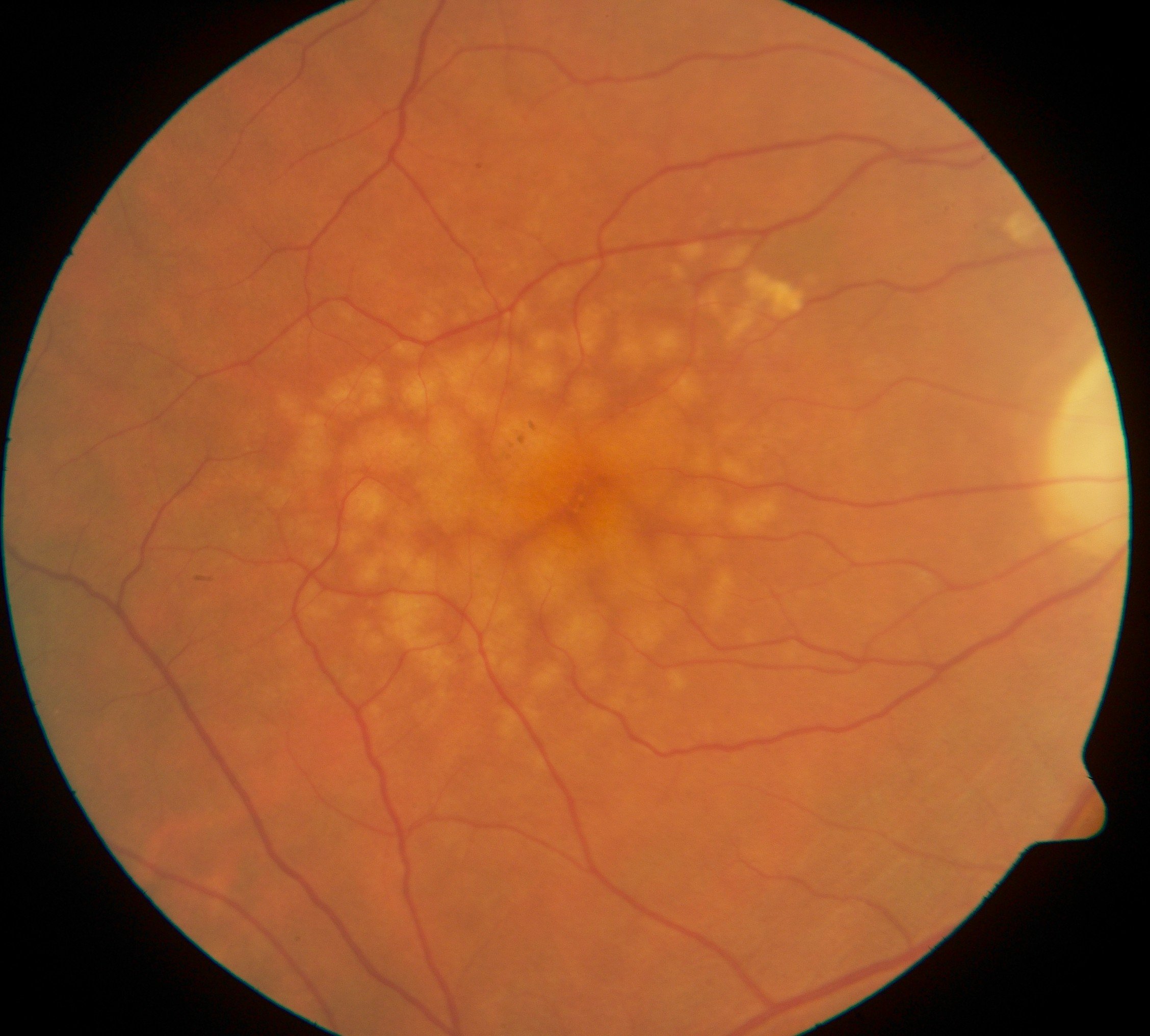 <p>PP: yellowish round spots</p><p>E: normal aging<br>age-related macular degeneration</p><p>CM: yellowish round spots<br>between optic disc+macula</p>