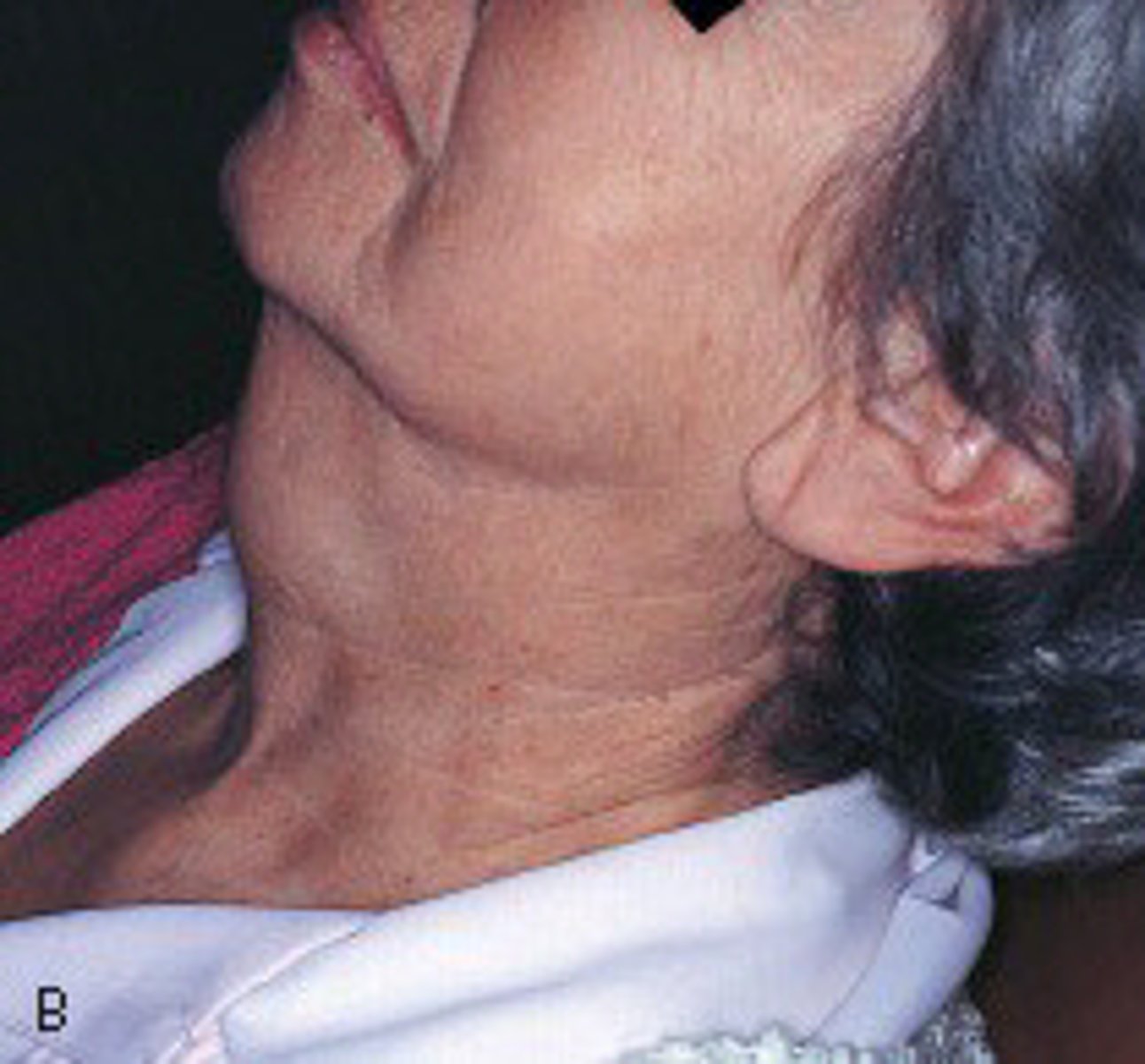 <p>thyroglossal duct</p><p>A thyroglossal duct cyst appears on the lateral neck and slowly increases in size. It is painless and feels soft. Histologic examination shows an epithelium-lined sac filled with clear, yellow fluid. A branchial cleft cyst is located on the lateral neck at the anterior border of the sternocleidomastoid muscle. A median palatine cyst is a well-defined unilocular radiolucency located in the midline of the hard palate. A globulomaxillary cyst is a well-defined, pear-shaped radiolucency found between the roots of a maxillary lateral incisor and cuspid.</p>