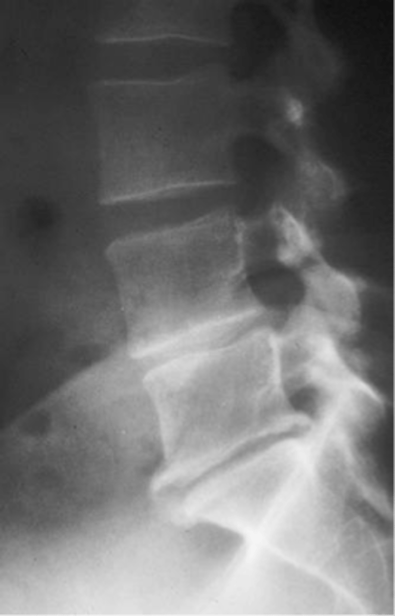 <p>ID type of degenerative spine disease in the lumbar spine</p>