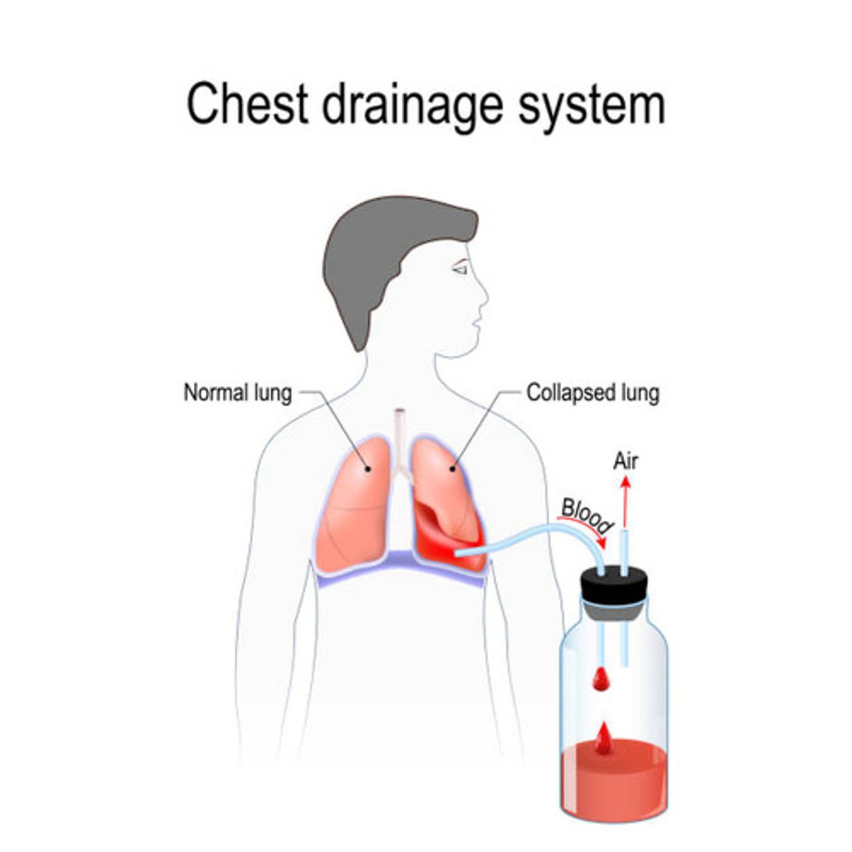 <p>- chest tube into 8-9th ICS (INSTEAD OF 2nd)</p><p>- blood settles with gravity in the lower lung regions, why we need lower needle/chest tube placement</p>