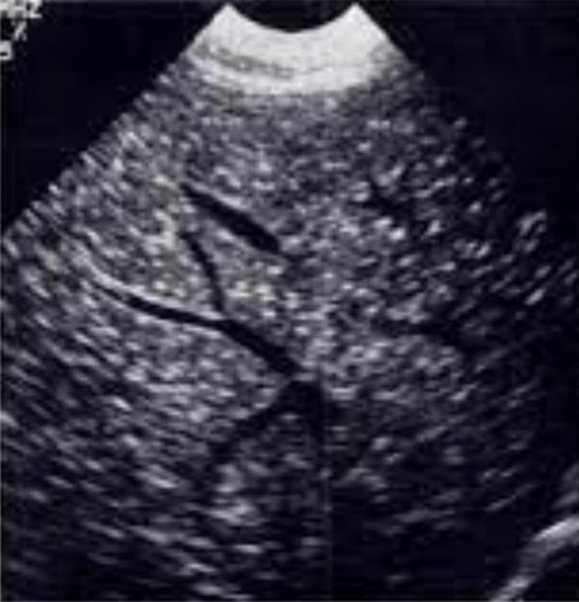 <p>Fungal infection</p><p>Seen with HIV-AIDS</p><p>Presents as multiple, small, echogenic foci throughout the liver</p>