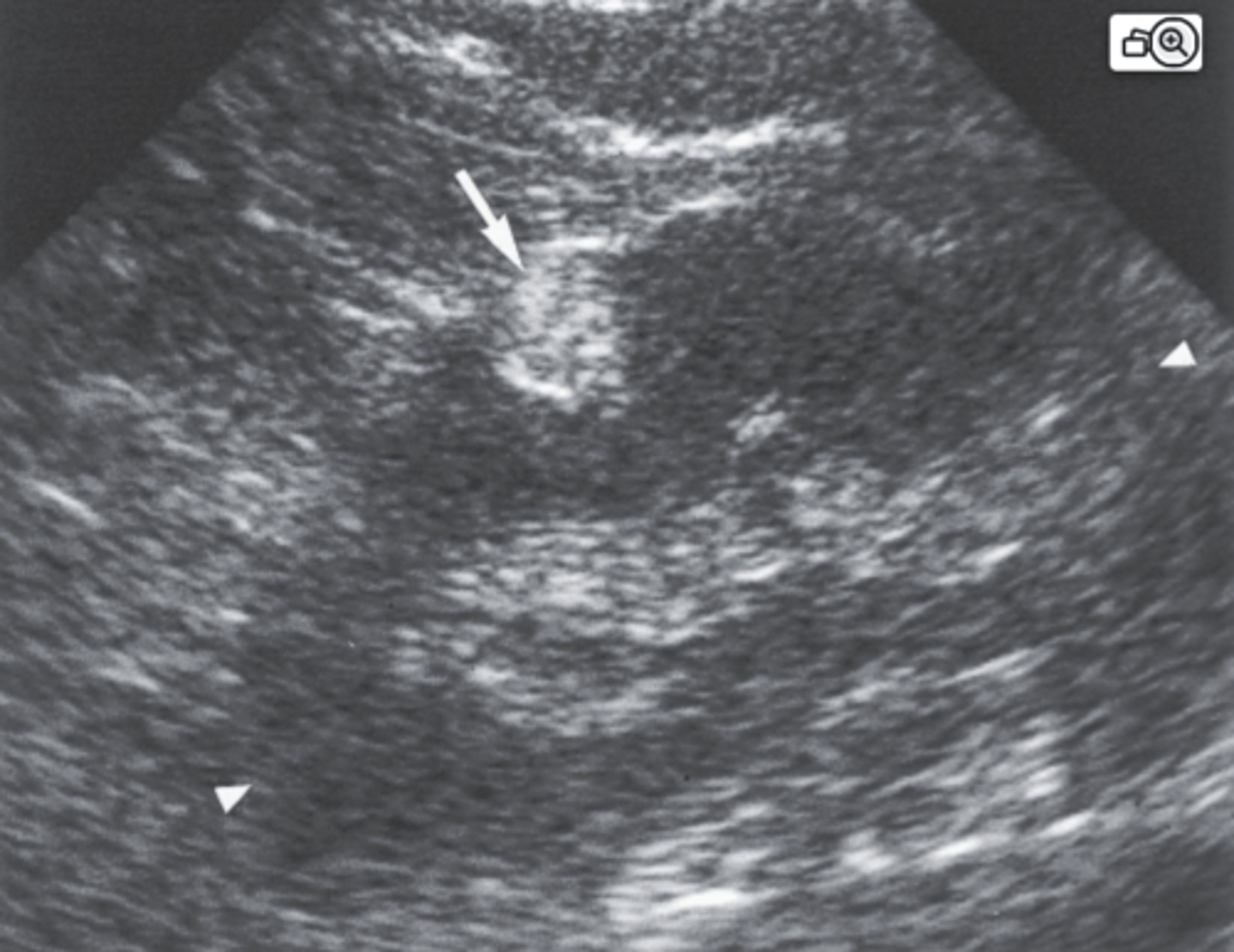 <p>d. Angiomyolipoma</p>