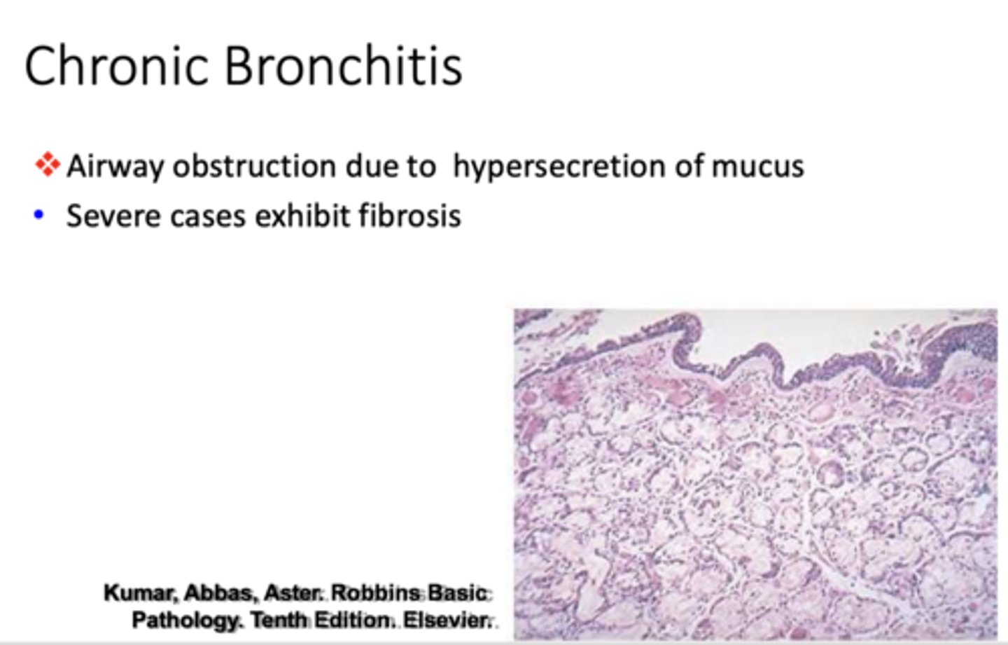 <p>Chronic Bronchitis</p>