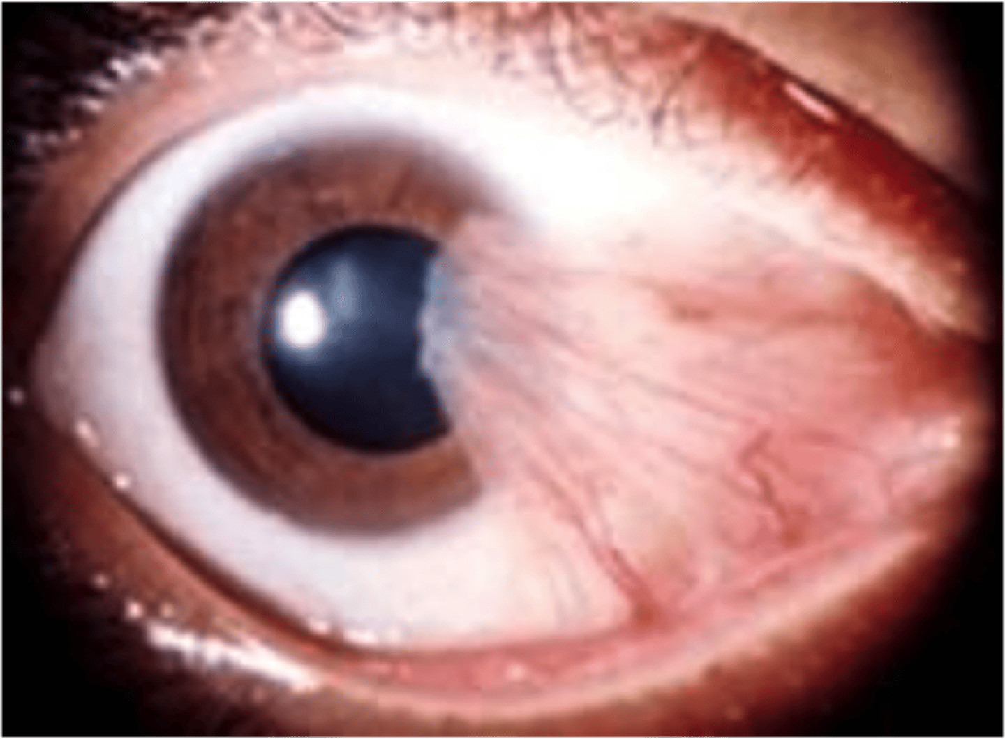 <p>Information for Condition:</p><p>-Fleshy triangular growth of bulbar conjunctiva</p><p>-See solar elastosis &amp; neovascularizaiton</p><p>-Extends onto cornea from limbus, and may be biopsied to evaluate for Squamous Carcinoma</p>